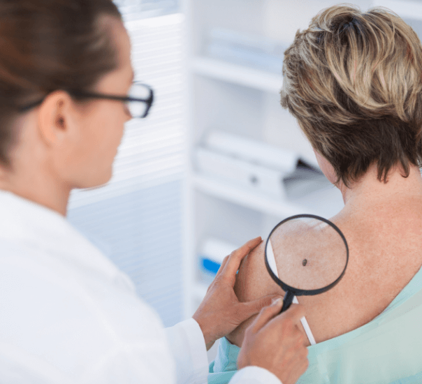 melanoma diagnosis at truderm adult dermatology