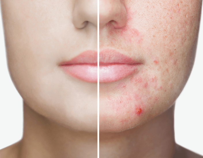 Truderm adult dermatology acne